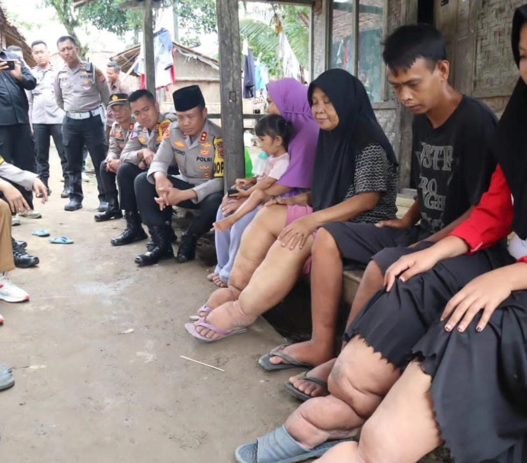 Satu Keluarga di Lebak Derita Penyakit Kaki Gajah, Kapolres Berikan Bantuan Sembako