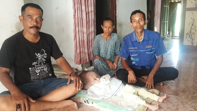 Bayi di Sepatan Mengidap Hidrosefalus